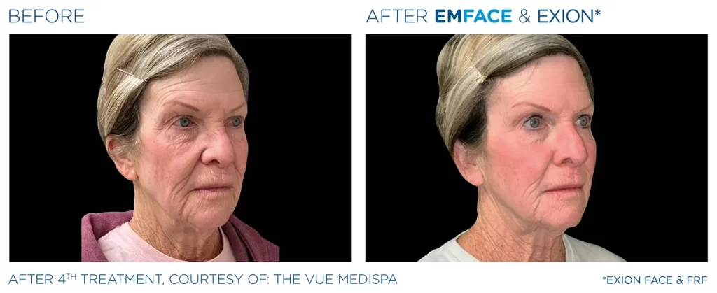 Emface Befor After 1