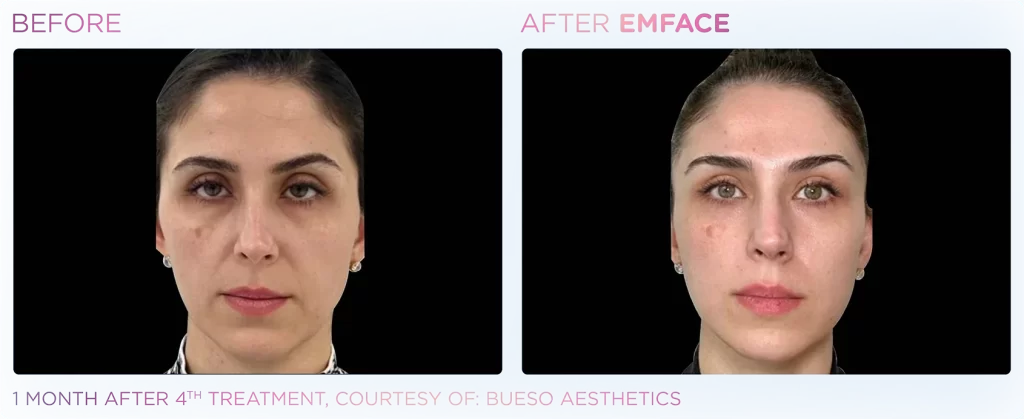 Emface Befor After 3