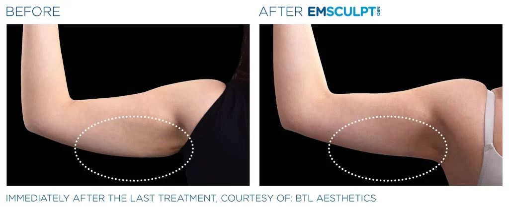 Emscuplt Neo Before After 1