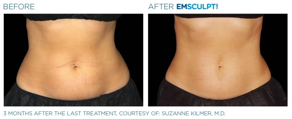Emscuplt Neo Before After 2