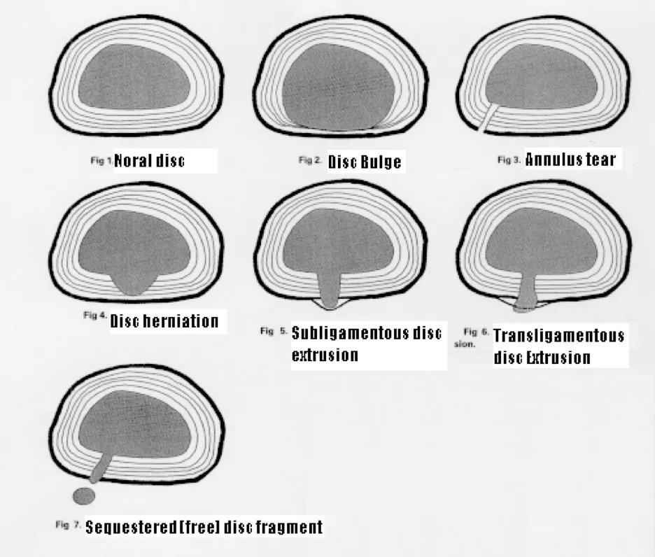 Anatomy Of A Disc